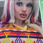 Ansia de belleza: estudiante búlgara agranda sus labios y no puede parar