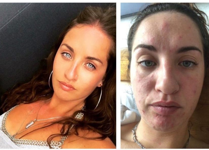 Apartment killer: the girl almost died from mold on the walls of the house