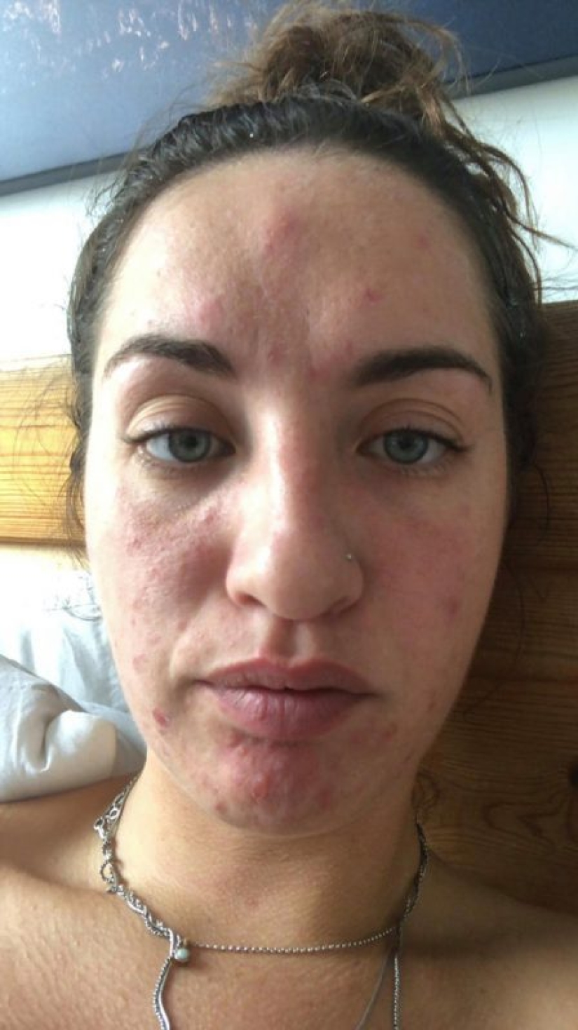 Apartment killer: the girl almost died from mold on the walls of the house