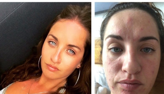 Apartment killer: the girl almost died from mold on the walls of the house Apartment killer: the girl almost died from mold on the walls of the house