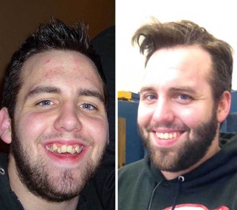 Así es como los frenillos cambian radicalmente una sonrisa y una vida