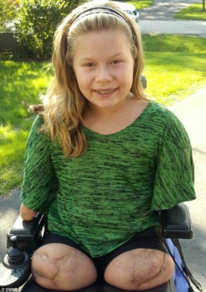 Because of the terrible virus, the girl's limbs were amputated, but she learned to play the piano Because of the terrible virus, the girl's limbs were amputated, but she learned to play the piano