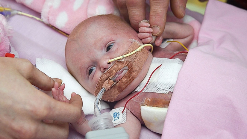 British doctors saved a baby girl who was born with her heart out British doctors saved a baby girl who was born with her heart out