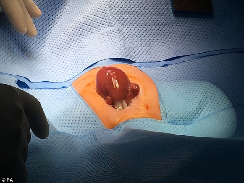 British doctors saved a baby girl who was born with her heart out British doctors saved a baby girl who was born with her heart out