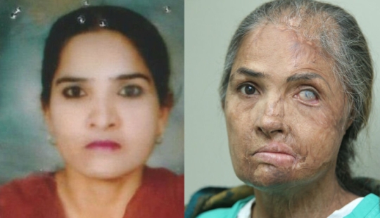 British surgeon performs free eyebrow transplantation for acid attack victims