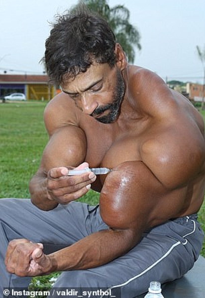 Bulbosaurus from Brazil: former drug addict gives himself oil injections
