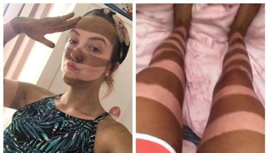 Cebra en cuarentena: una mujer hizo un bronceado a rayas y lo considera una idea brillante