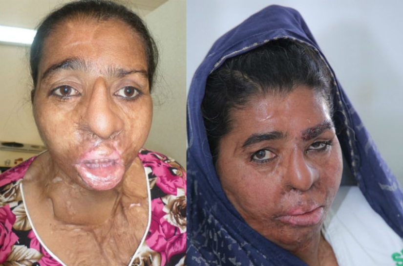 Cirujano británico realiza trasplante de cejas gratuito para víctimas de ataques con ácido Cirujano británico realiza trasplante de cejas gratuito para víctimas de ataques con ácido