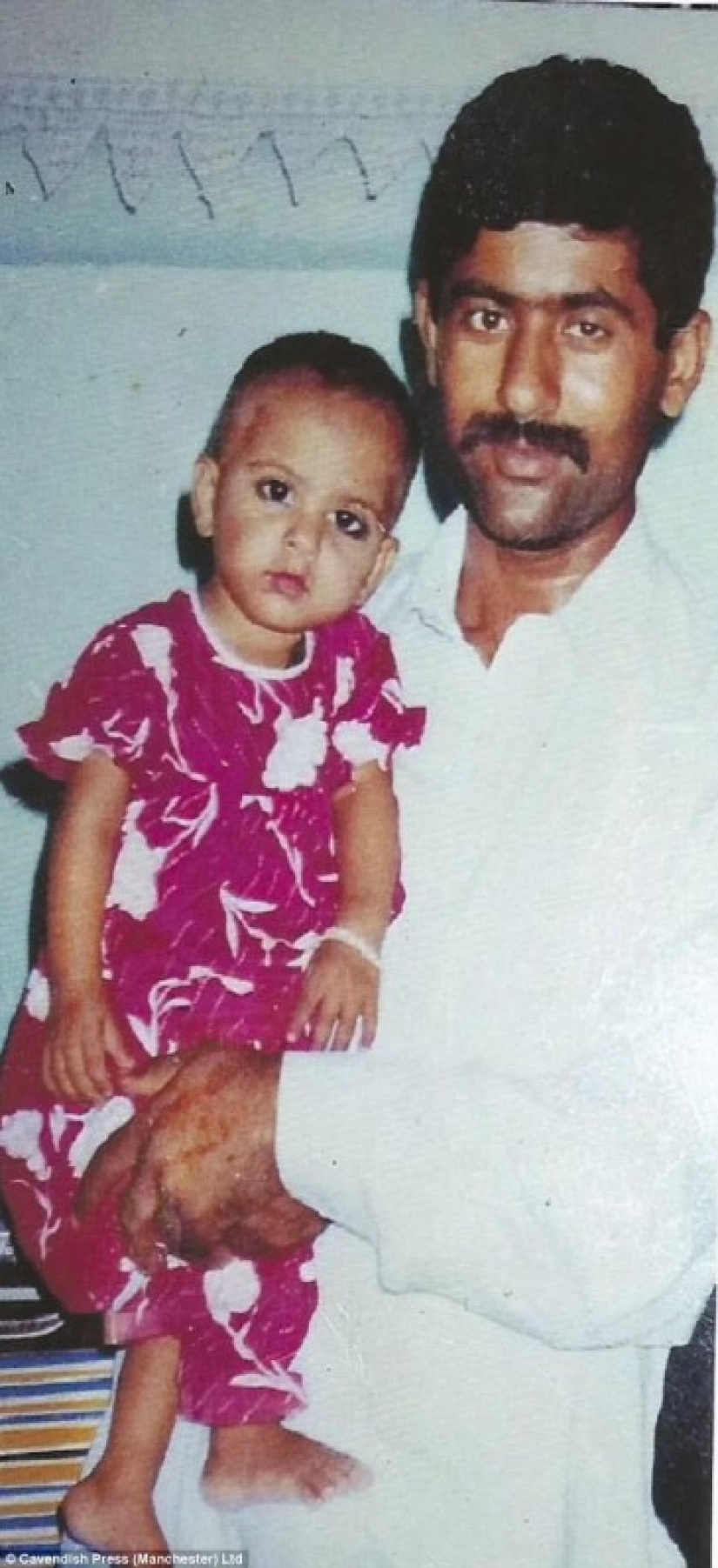 Cirujano británico realiza trasplante de cejas gratuito para víctimas de ataques con ácido Cirujano británico realiza trasplante de cejas gratuito para víctimas de ataques con ácido