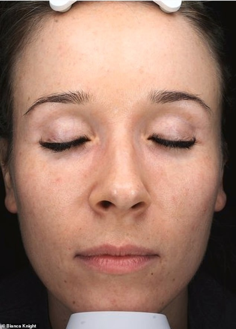 Cómo envejecen la piel un teléfono y una computadora: una joven se horrorizó por los efectos de la radiación en su cara