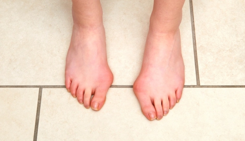 Cómo los pies muestran el estado de salud: 8 señales sobre enfermedades graves