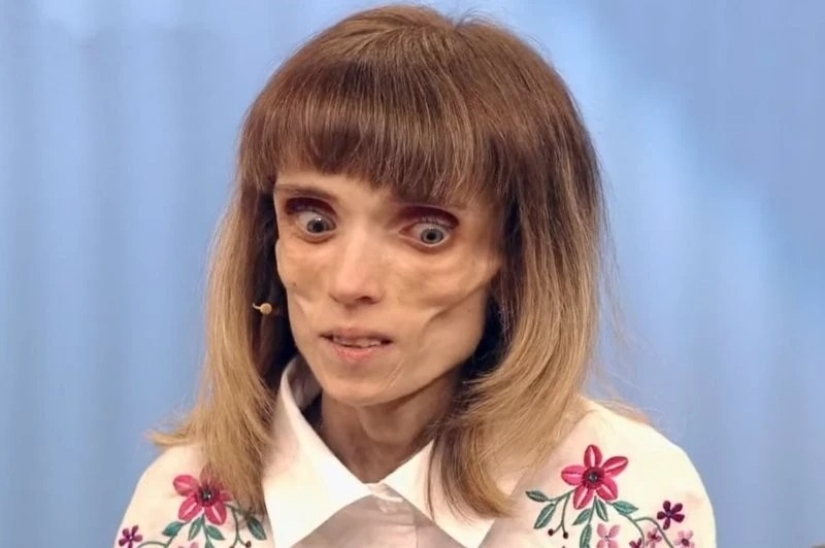 Cómo se ve ahora Kristina Koryagina — una mujer rusa que pesaba 17 kg