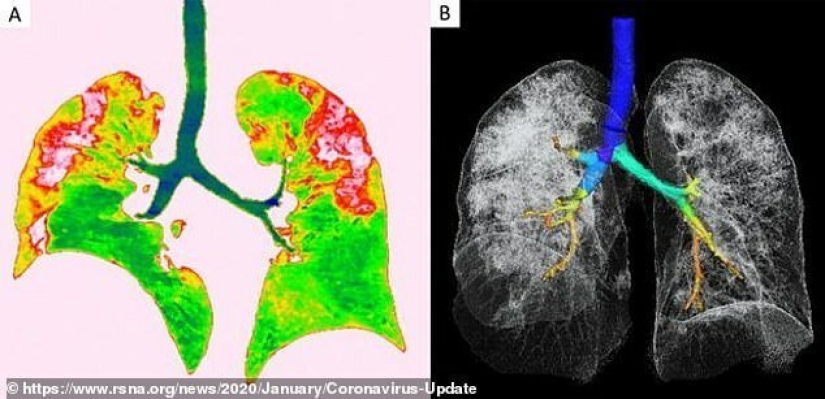 Cómo son los pulmones afectados por el coronavirus Cómo son los pulmones afectados por el coronavirus