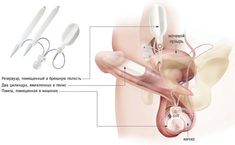 Cómo vive un hombre con un pene biónico Cómo vive un hombre con un pene biónico