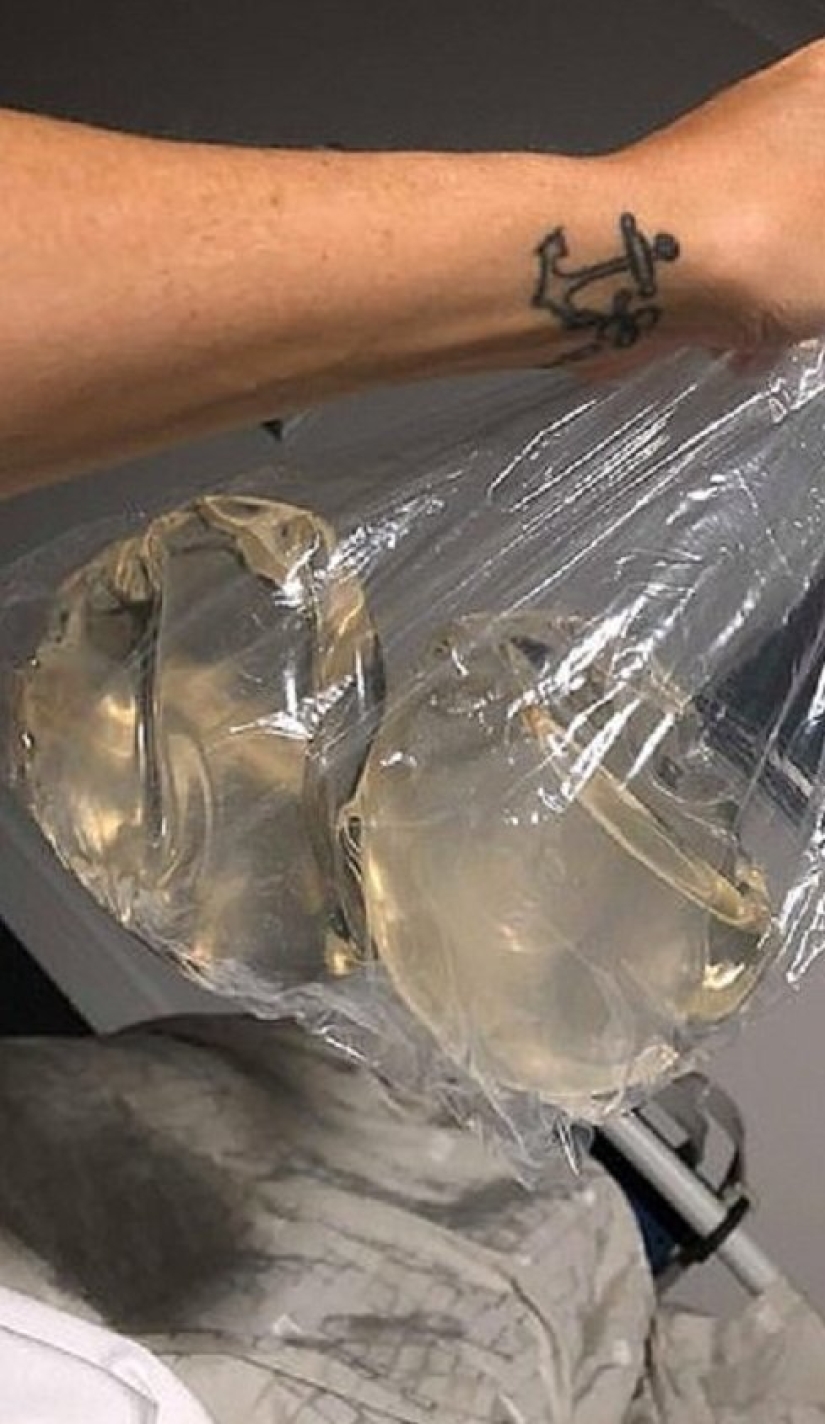 "Con ellos, mi vida se convirtió en un infierno": una mujer australiana contó por qué se deshizo de los implantes mamarios