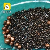 Dama de piedra: durante la operación, se extrajeron más de 2,000 cálculos biliares de la vesícula biliar de la mujer china