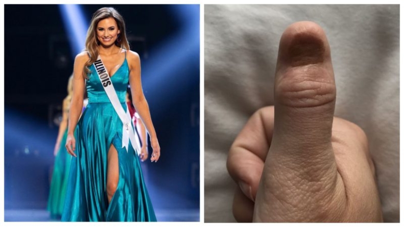 Deadly manicure: the beauty queen was diagnosed with cancer after nail extensions