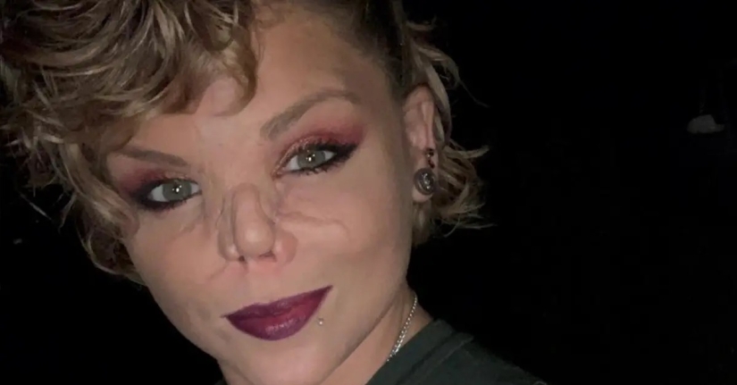 Disfigured love: a pit bull bit off a girl's nose, but she forgave him and continues to cuddle with dogs Disfigured love: a pit bull bit off a girl's nose, but she forgave him and continues to cuddle with dogs