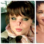 Disfigured love: a pit bull bit off a girl's nose, but she forgave him and continues to cuddle with dogs