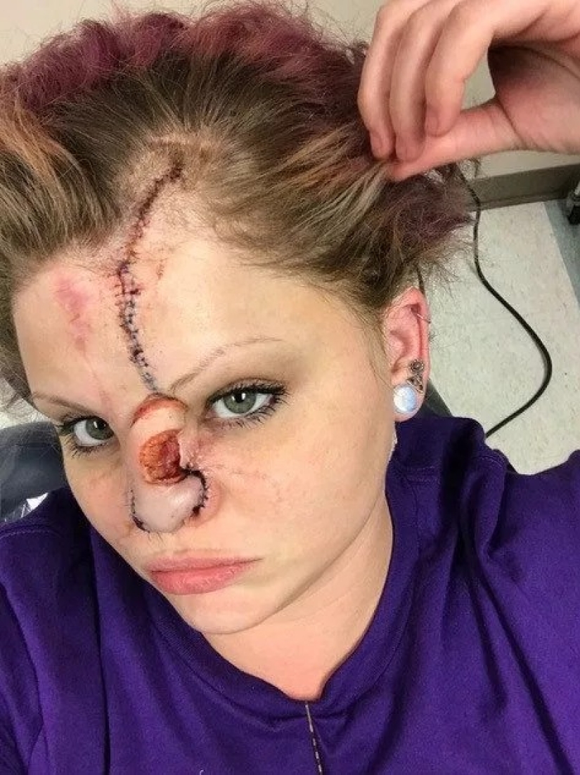 Disfigured love: a pit bull bit off a girl's nose, but she forgave him and continues to cuddle with dogs Disfigured love: a pit bull bit off a girl's nose, but she forgave him and continues to cuddle with dogs
