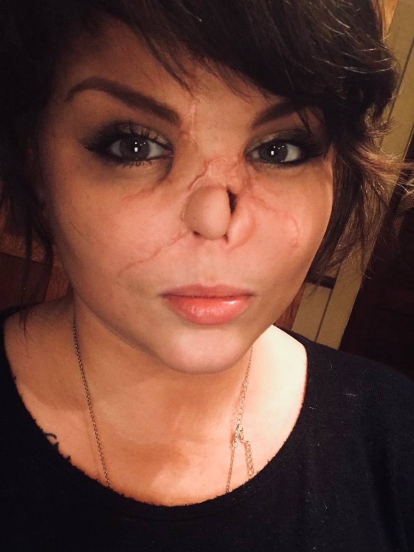 Disfigured love: a pit bull bit off a girl's nose, but she forgave him and continues to cuddle with dogs Disfigured love: a pit bull bit off a girl's nose, but she forgave him and continues to cuddle with dogs