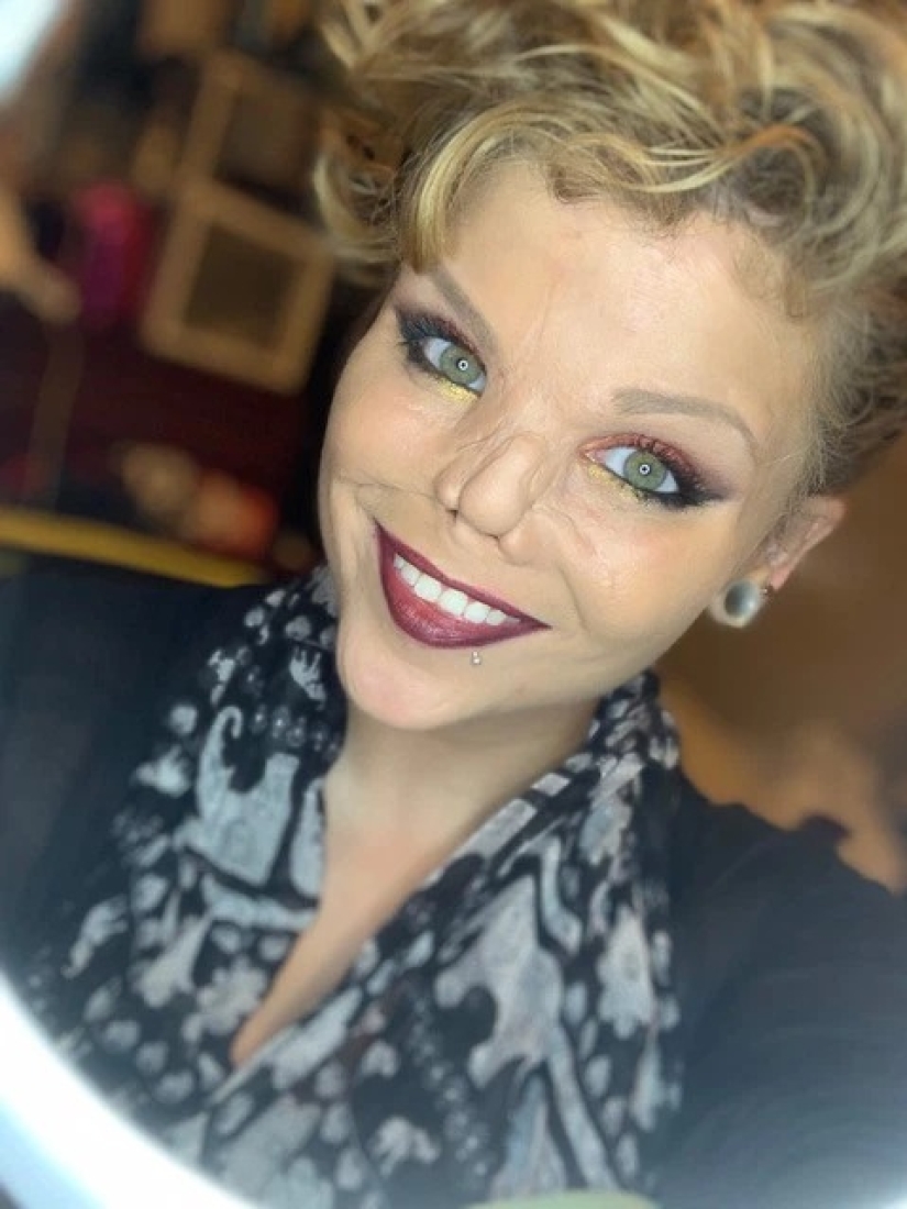 Disfigured love: a pit bull bit off a girl's nose, but she forgave him and continues to cuddle with dogs Disfigured love: a pit bull bit off a girl's nose, but she forgave him and continues to cuddle with dogs