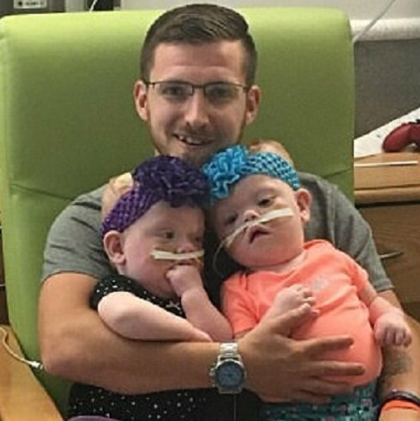 El derecho a la vida: gemelos siameses de 1,5 años, nacidos con la cabeza fusionada, se recuperaron de una operación complicada y se regocijan todos los días