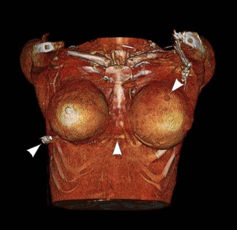 El pecho de silicona salvó la vida de su amante al detener una bala