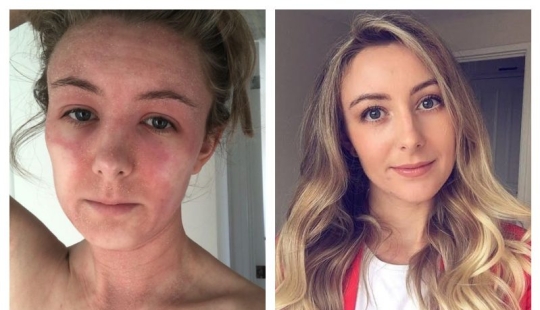 El resultado es evidente: una mujer se deshizo de la horrible eczema, lanzando crema con esteroides y convertirse en un vegetariano