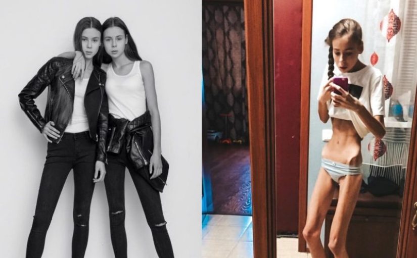 En el cautiverio de Kashchey: la delgadez mortal casi mata a las hermanas gemelas de Rusia