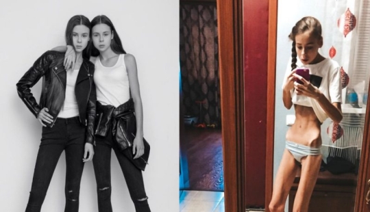 En el cautiverio de Kashchey: la delgadez mortal casi mata a las hermanas gemelas de Rusia