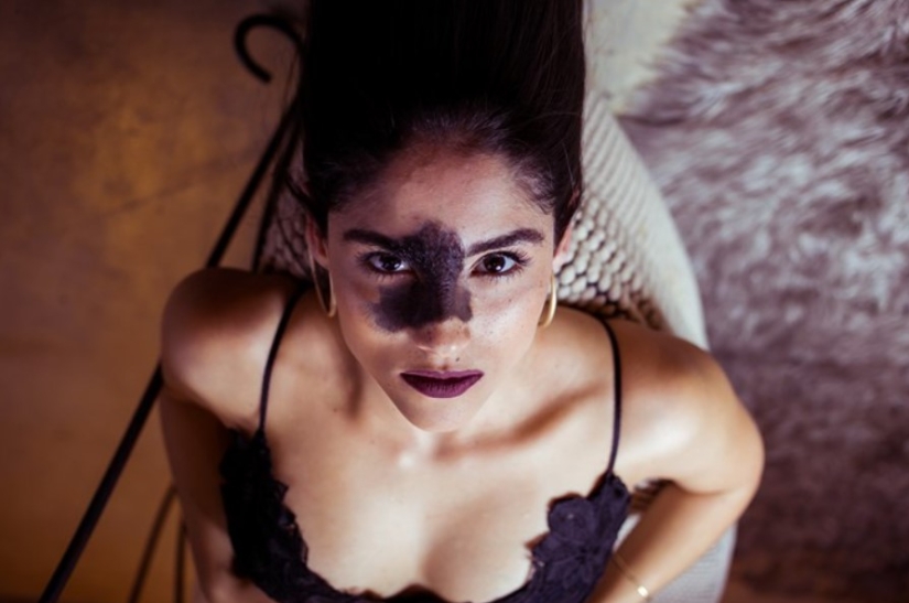 Everyone mocked this girl because of her birthmark, and she took and became a model Everyone mocked this girl because of her birthmark, and she took and became a model