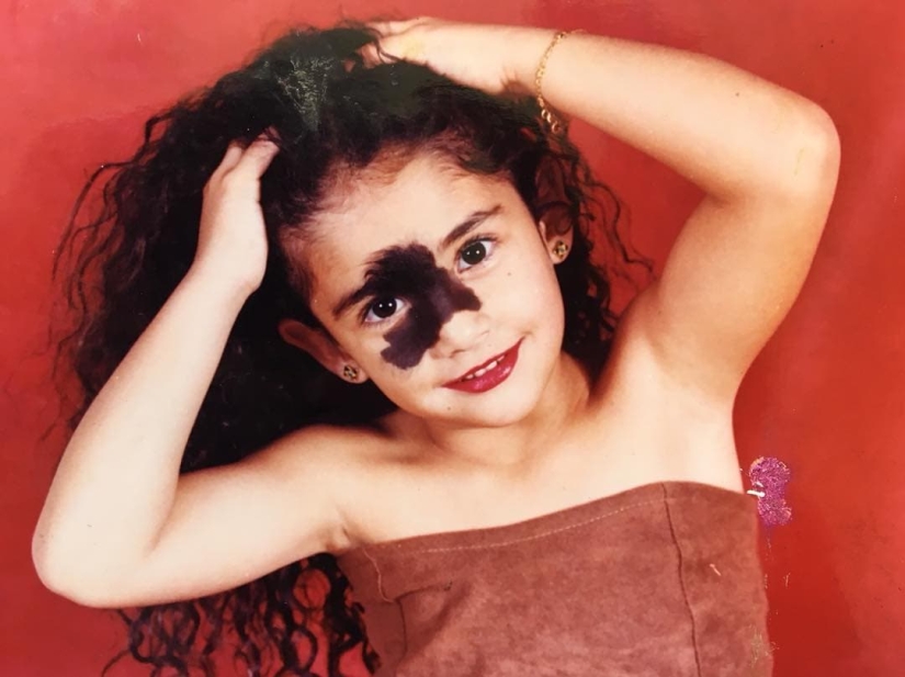 Everyone mocked this girl because of her birthmark, and she took and became a model Everyone mocked this girl because of her birthmark, and she took and became a model