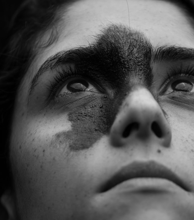 Everyone mocked this girl because of her birthmark, and she took and became a model Everyone mocked this girl because of her birthmark, and she took and became a model