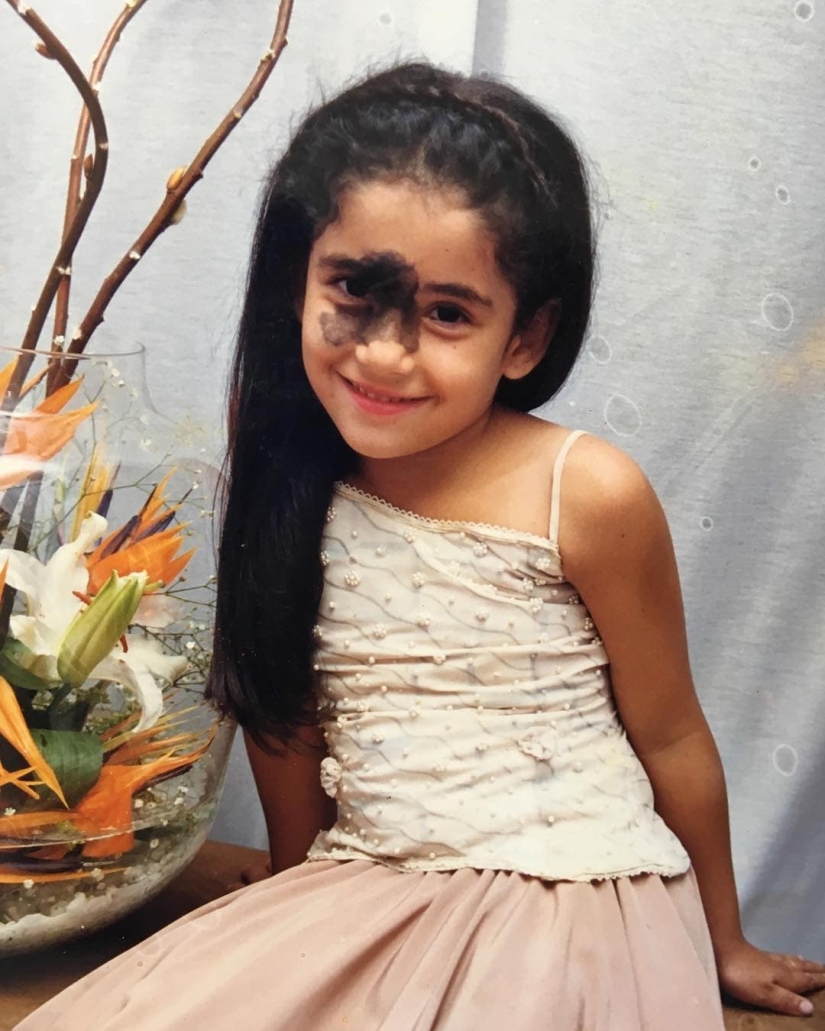 Everyone mocked this girl because of her birthmark, and she took and became a model Everyone mocked this girl because of her birthmark, and she took and became a model