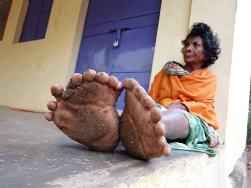 Fingers with a fan: a woman with 31 fingers got into the Guinness Book of Records