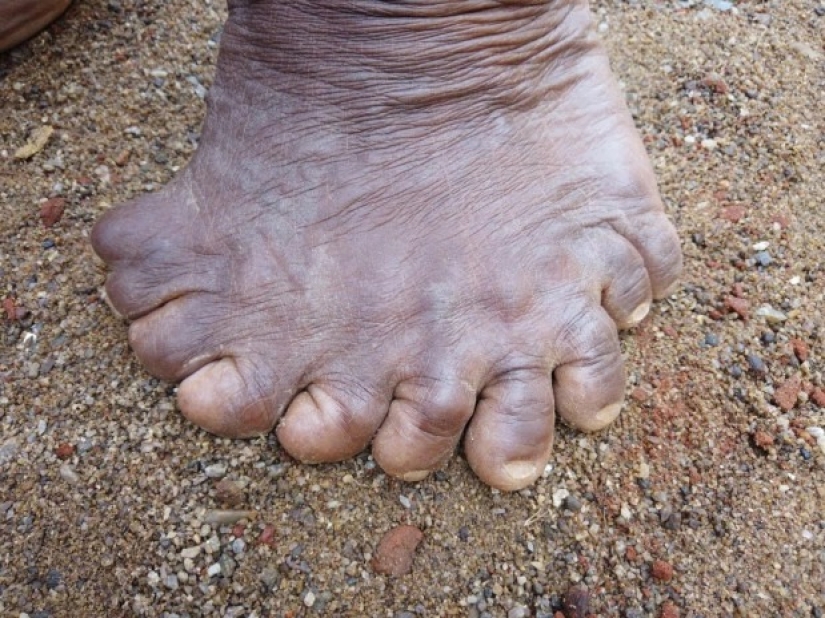 Fingers with a fan: a woman with 31 fingers got into the Guinness Book of Records