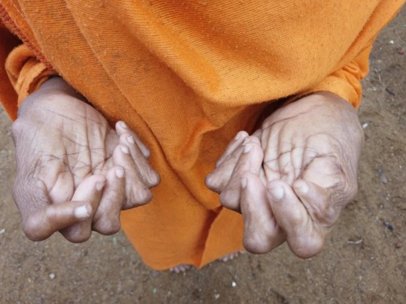 Fingers with a fan: a woman with 31 fingers got into the Guinness Book of Records
