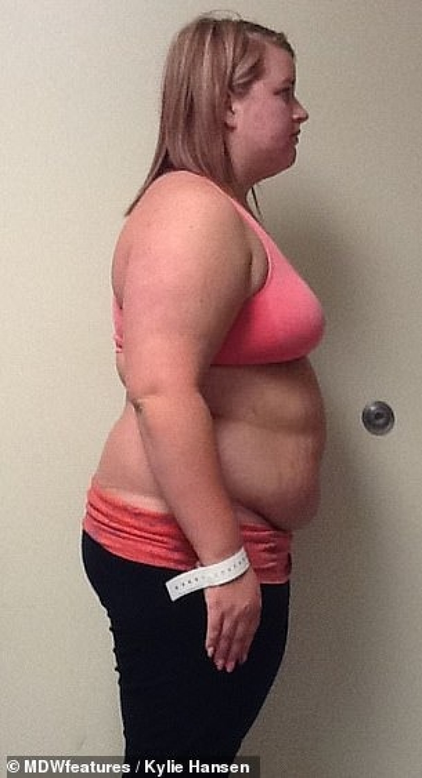 From extreme to extreme: a woman lost 50 kg, but could not stop there