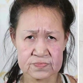 From grandmother to girl: a 15-year-old Chinese woman with an old woman's face underwent surgery