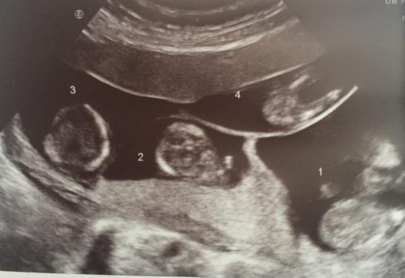 Happiness multiplied by 4 and worries divided by 2: the mathematics of raising wonderful quadruplets