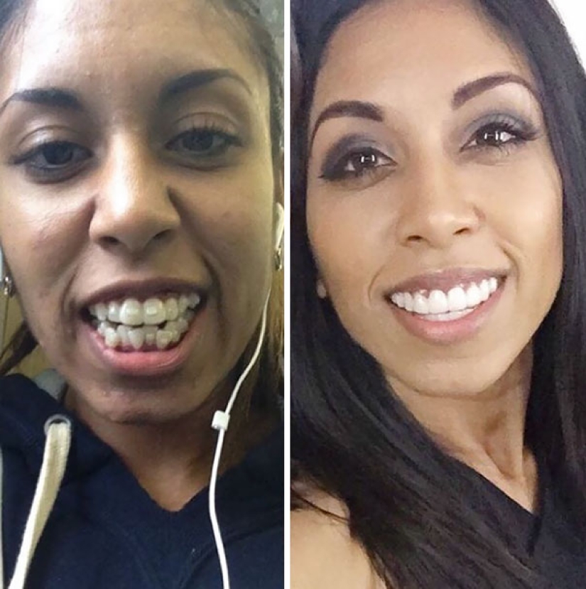Here's how radically braces change a smile and life