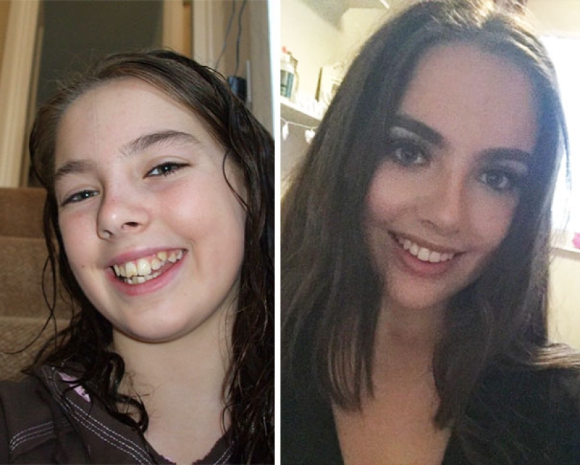 Here's how radically braces change a smile and life