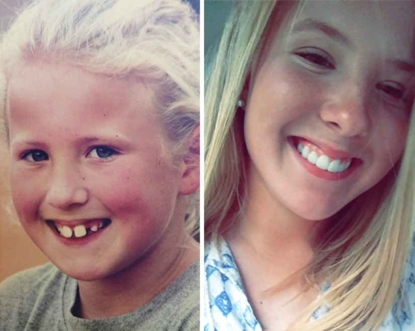 Here's how radically braces change a smile and life