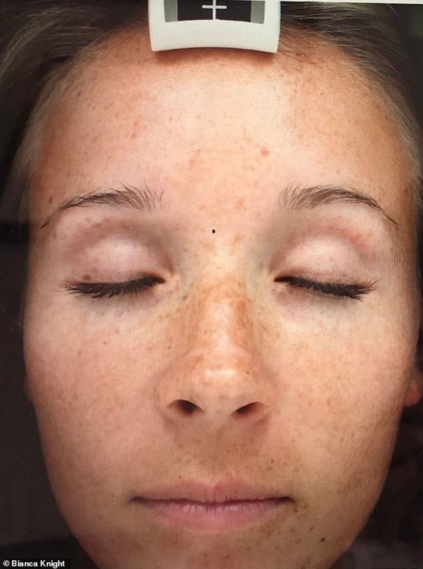 How a phone and a computer age the skin: a young woman was horrified by the effects of radiation on her face