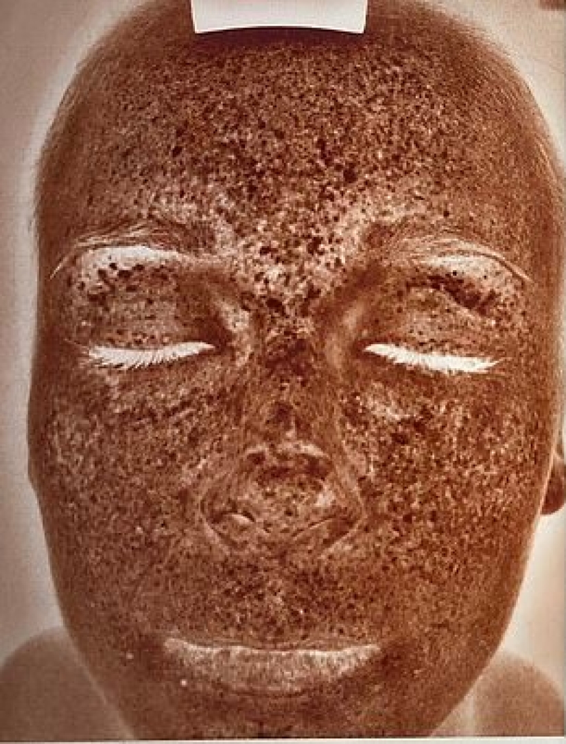 How a phone and a computer age the skin: a young woman was horrified by the effects of radiation on her face