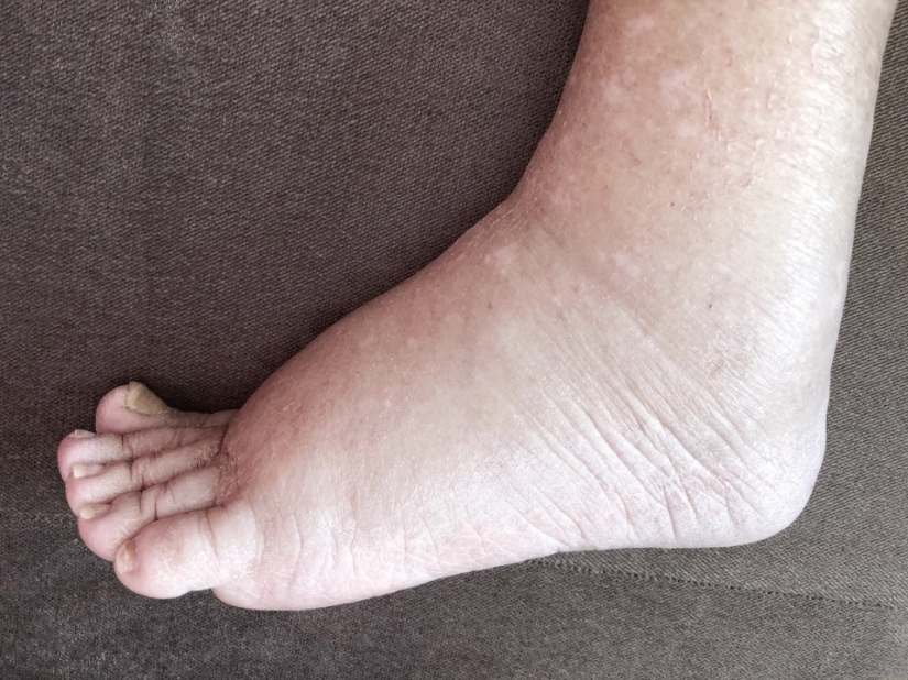 How the feet display the state of health — 8 signals about serious diseases