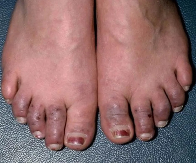 How the feet display the state of health — 8 signals about serious diseases