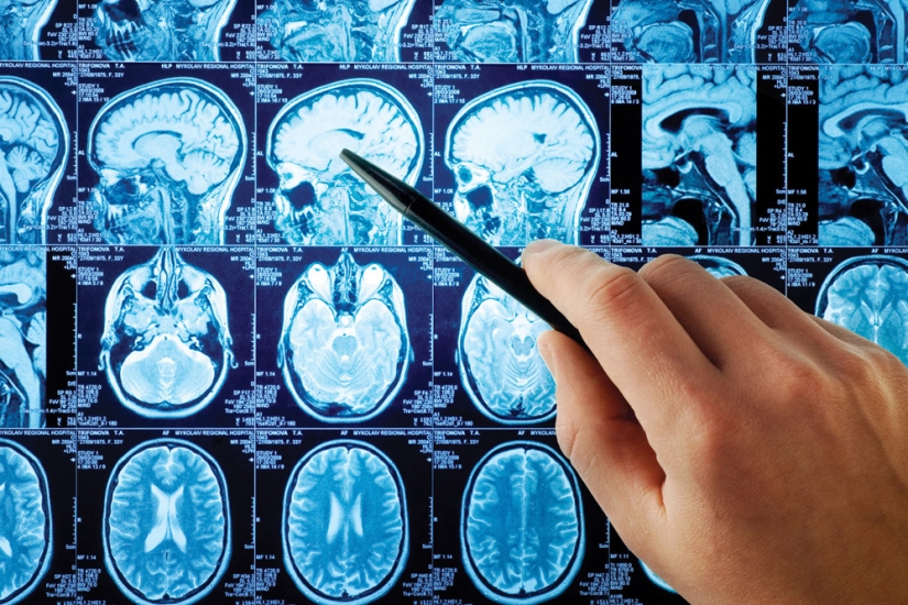 "Icons jump out of the monitor" and other strange signs of Alice in Wonderland syndrome