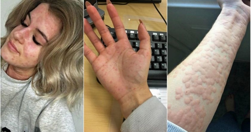 "I'm afraid to open the refrigerator": how a girl with an allergy to cold lives